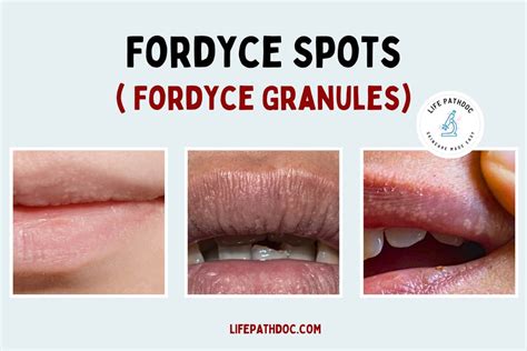 grain de fordyce|Fordyce spots: Quick and Informative guidance